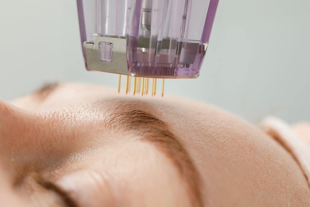 Microneedle,Mesotherapy.,Woman,Receiving,Micro,Needling,Rejuvenation,Treatment,In,A
