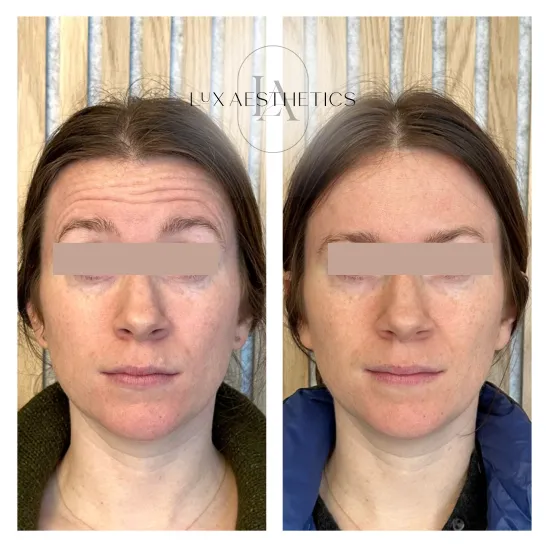 Before and After Image: Botox - front