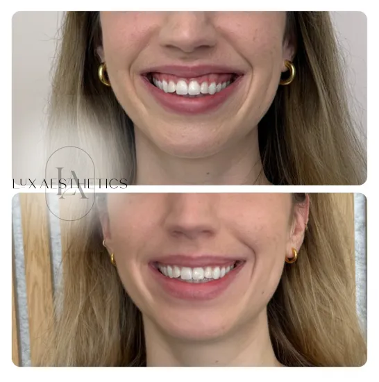 Before and After Image: Botox - front
