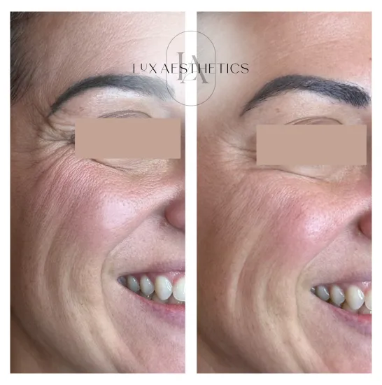 Before and After Image: Botox - right-front-oblique