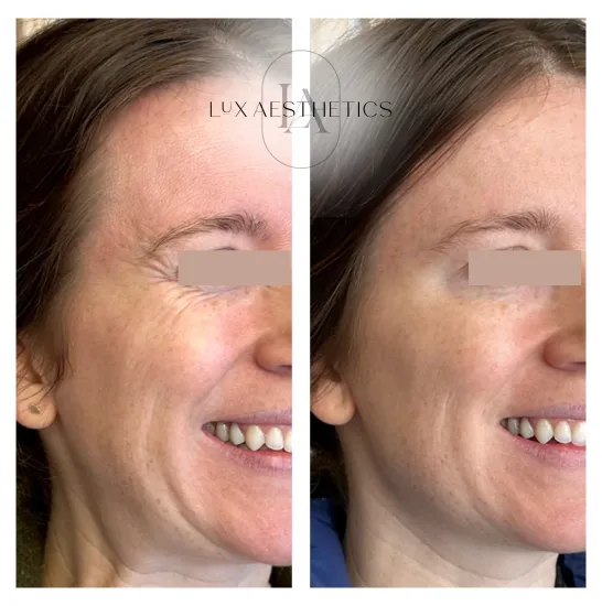 Before and After Image: Botox - right-front-oblique