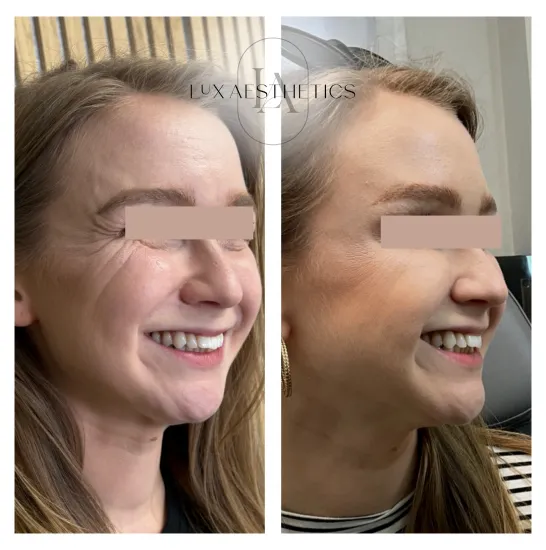 Before and After Image: Botox - right-front-oblique