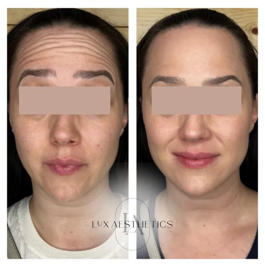 Before and After Image: Botox - front
