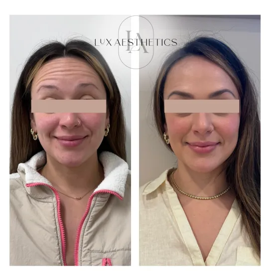 Before and After Image: Botox - front