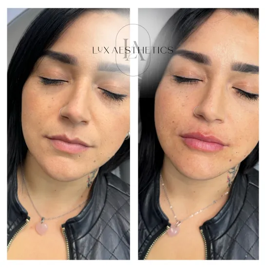 Before and After Image: Filler - left-front-oblique