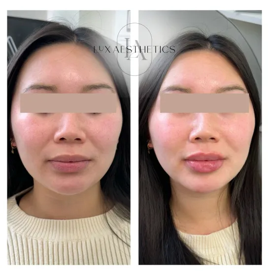Before and After Image: Filler - front