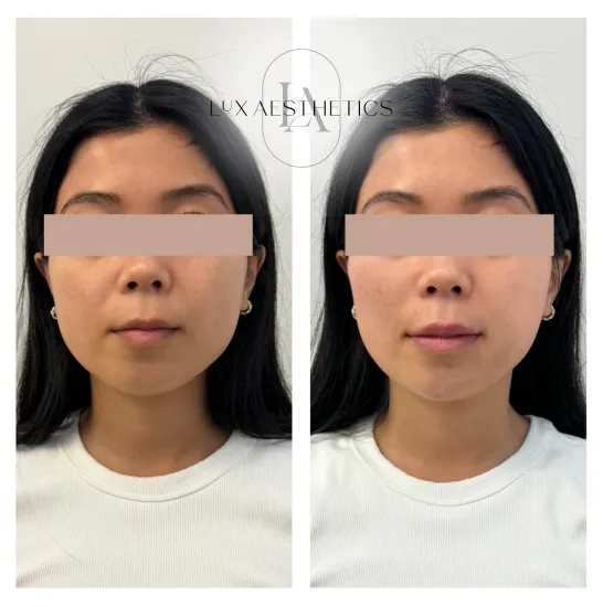 Before and After Image: Filler - front