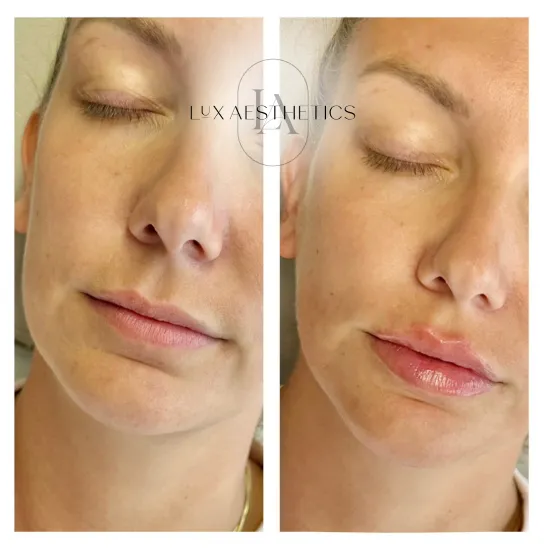Before and After Image: Filler - left-front-oblique
