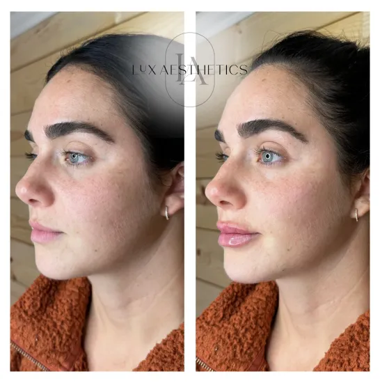 Before and After Image: Filler - left-front-oblique