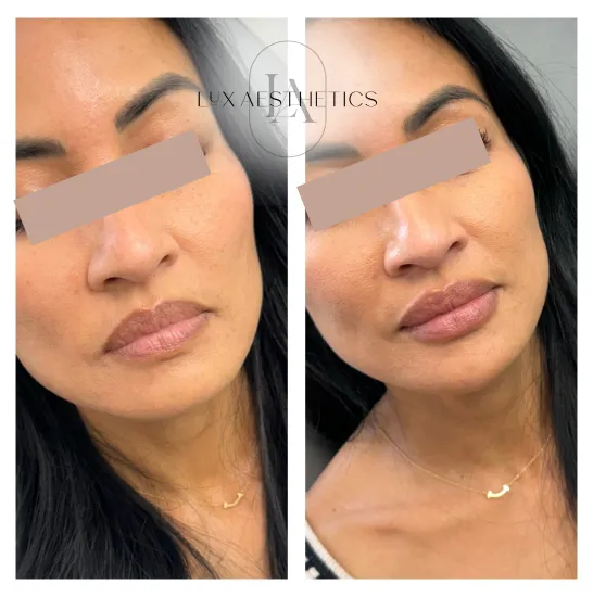 Before and After Image: Filler - right-front-oblique