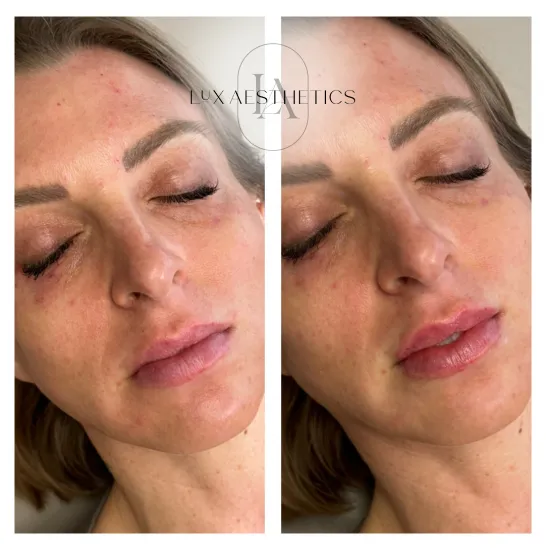 Before and After Image: Filler - right-front-oblique