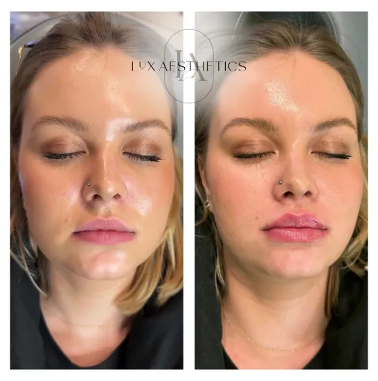 Before and After Image: Filler - front