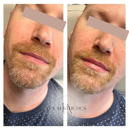 Before and After Image: Filler - left-front-oblique