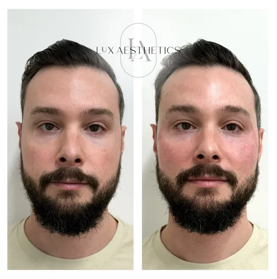 Before and After Image: Filler - front