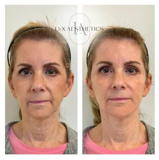 Before and After Image: Filler - front