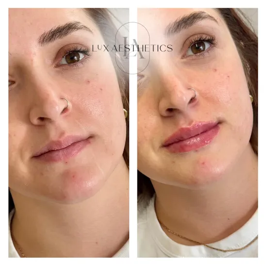 Before and After Image: Filler - right-front-oblique