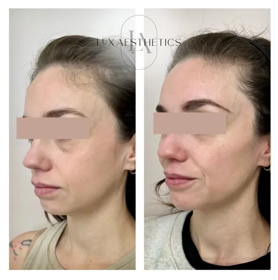 Before and After Image: Filler - left-front-oblique