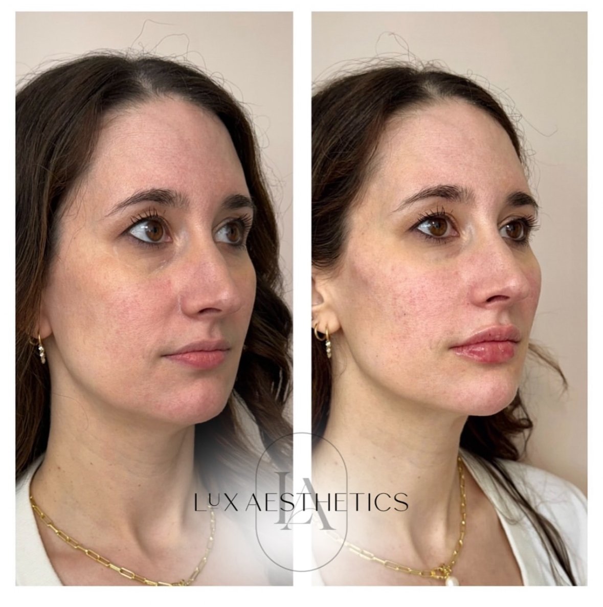 Before and After Image: Filler - right-front-oblique
