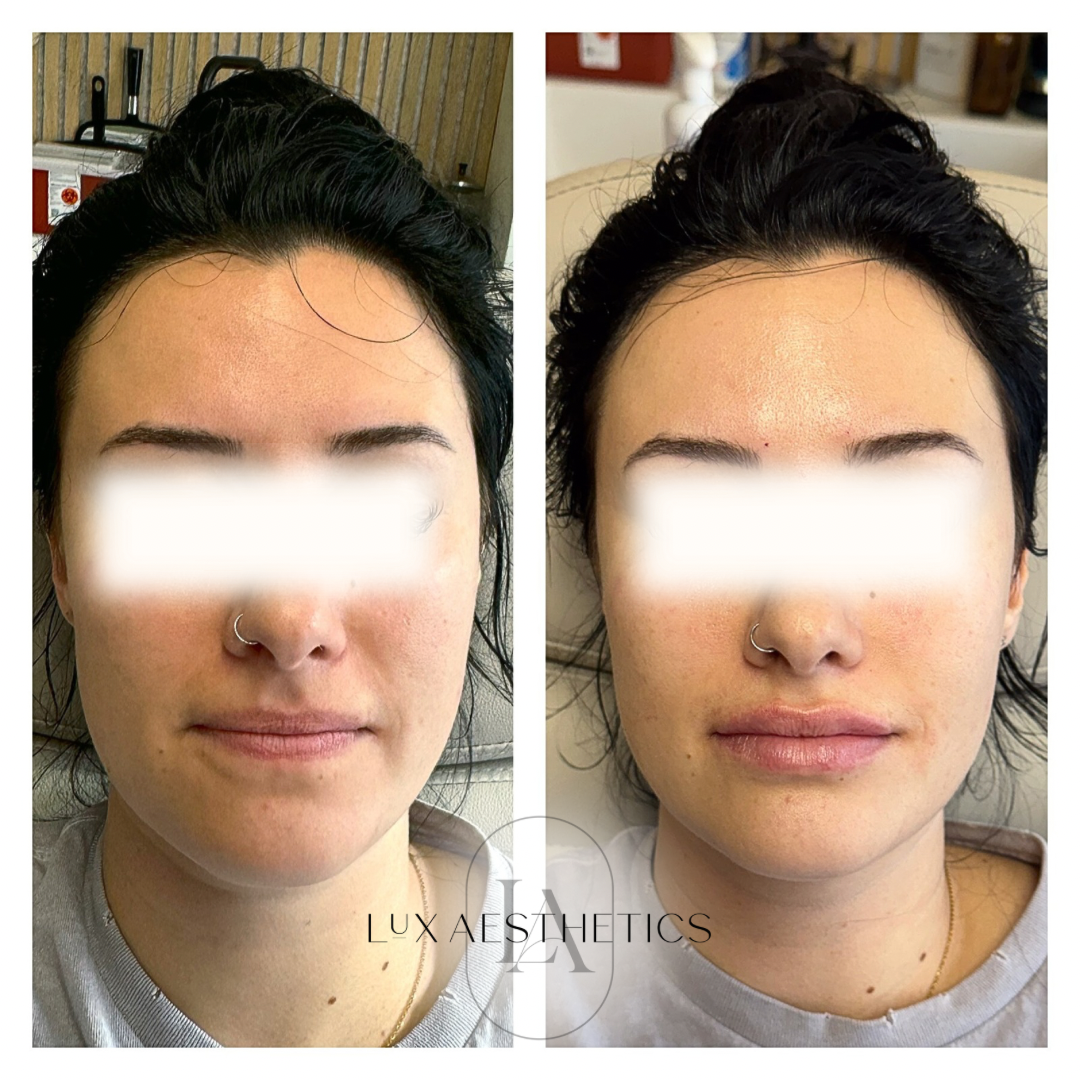 Before and After Image: Filler - front