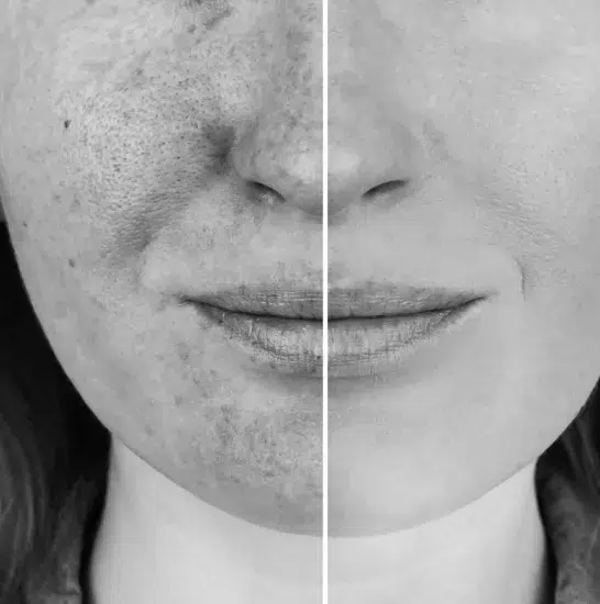 Before and After Image: IPL - front
