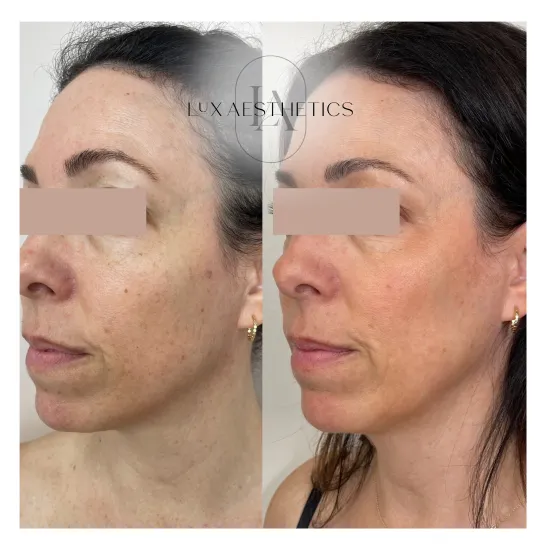 Before and After Image: IPL - left-front-oblique
