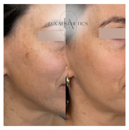 Before and After Image: IPL - right-front-oblique