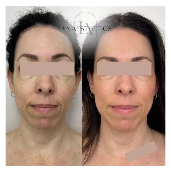 Before and After Image: IPL - front