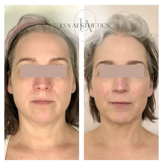 Before and After Image: Morpheus8 - front