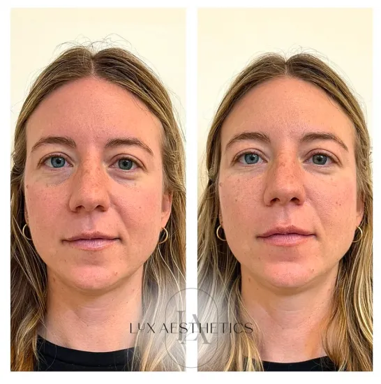 Before and After Image: PRF EZ Gel - front