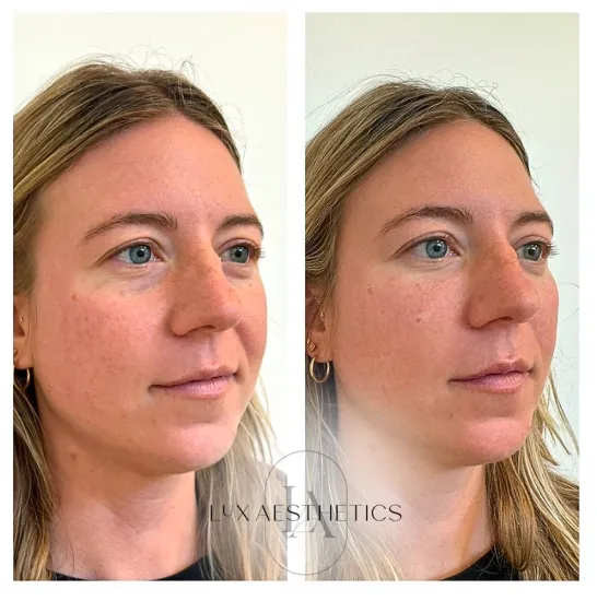 Before and After Image: PRF EZ Gel - right-front-oblique