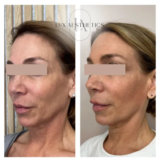 Before and After Image: Sculptra - 