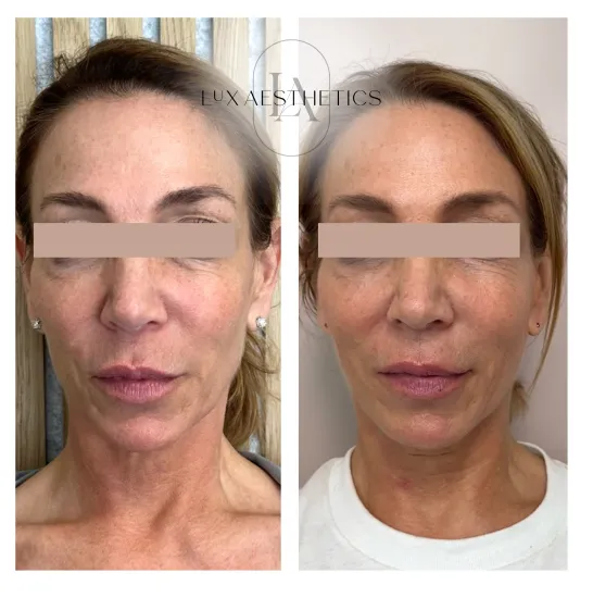 Before and After Image: Sculptra - front