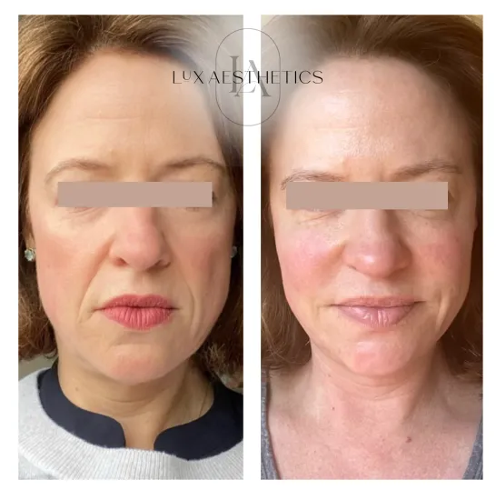 Before and After Image: Sculptra - front