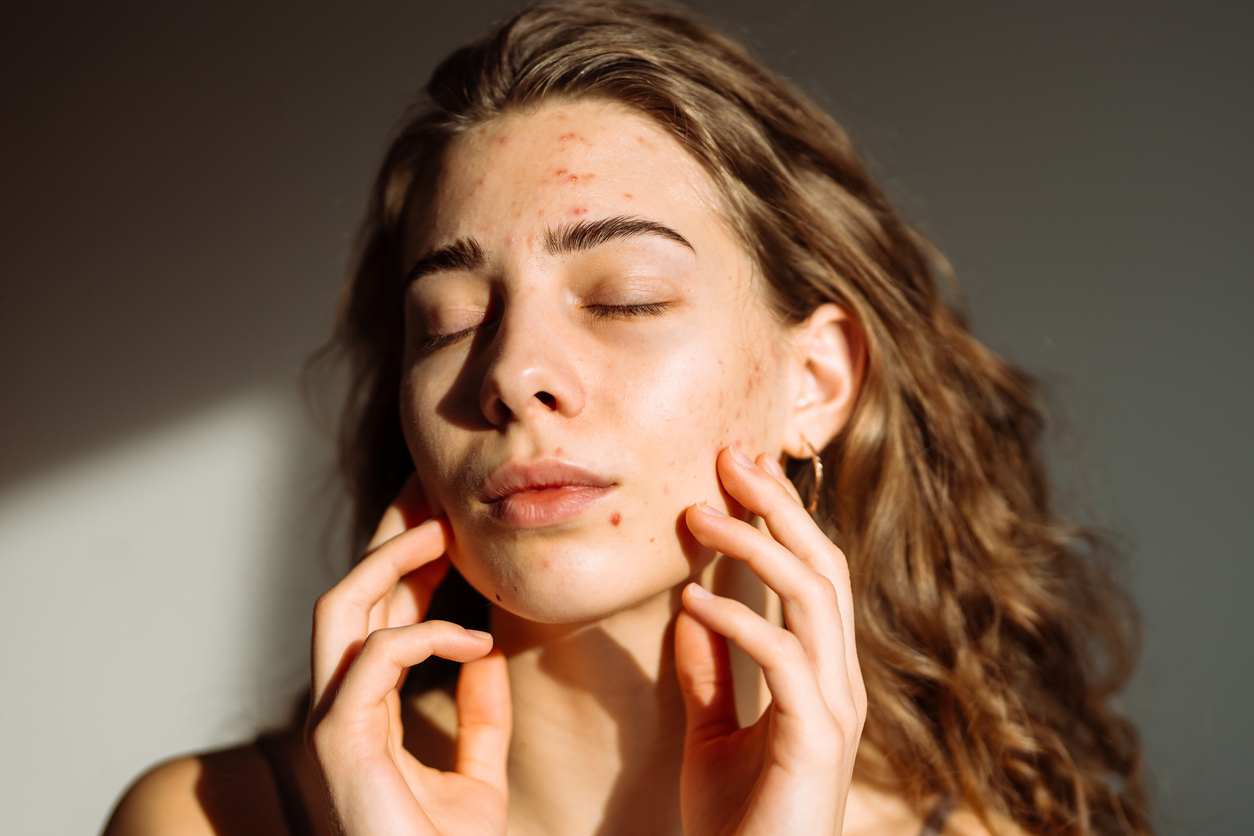 Portrait of a beautiful young woman with rash skin, scar.