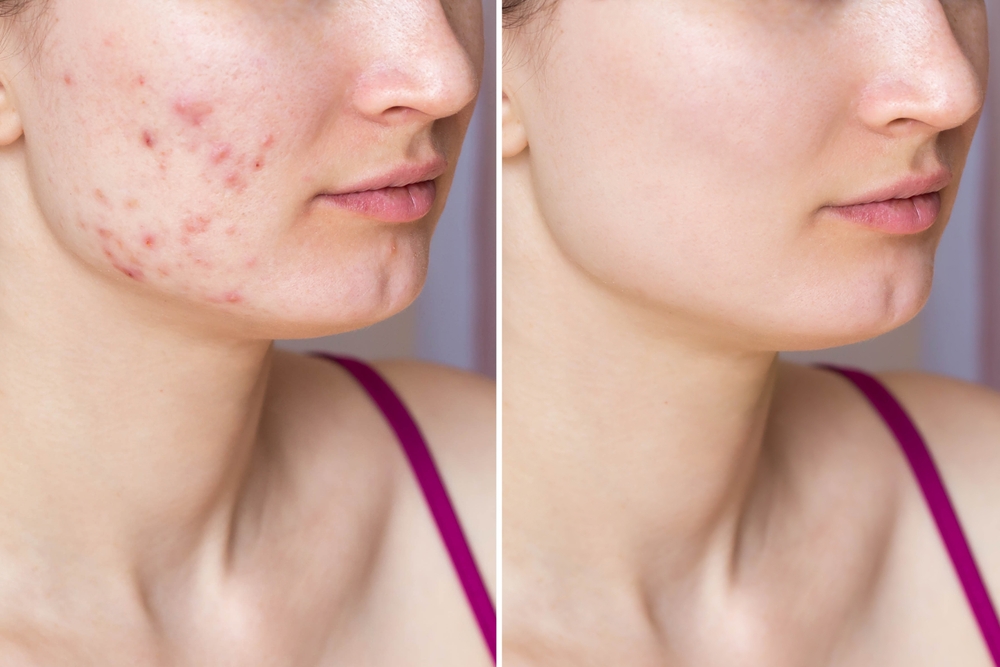Before and after photos of woman with acne who later undergoes acne boot camp.